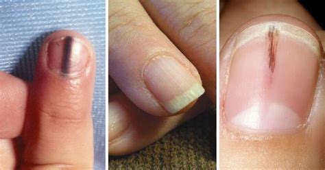 In addition to trauma, a common cause of black lines on nails is a nutritional deficiency. You Should Never Ignore These 9 Things Your Fingernails ...