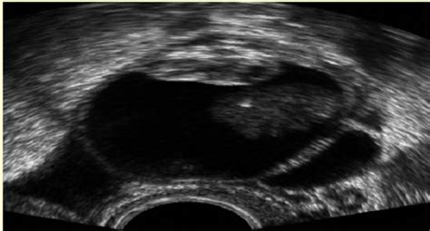 Transvaginal Sonography Of Dermoid Cyst Showing Echo Shadow Of Solid