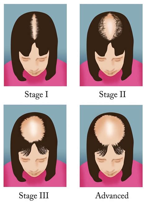 How To Fix Female Pattern Hair Loss Tips Faqs And Hair Care Best