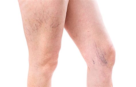 Types Of Varicose Veins