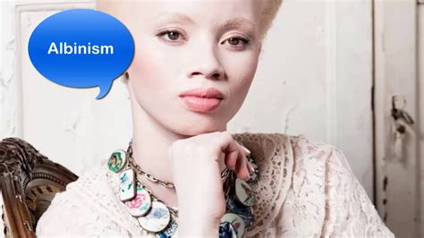 Albinism Symptoms Causes And Diagnosis Hot Sex Picture