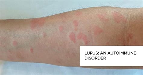 Lupus An Autoimmune Disorder Apollo Hospitals Blog