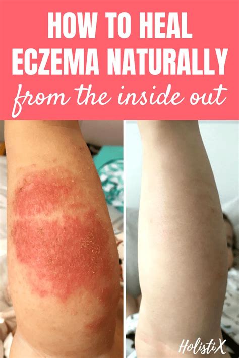 How To Heal Eczema Naturally From The Inside Out With Images