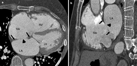 Septal Defects Radiology Key