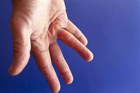 Everything You Need To Know About Dupuytrens Contracture