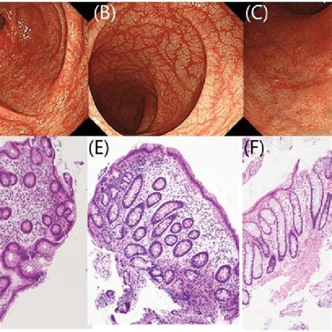 Endoscopic And Microscopic Images Of Colon Tissue With Colitis Ulcer