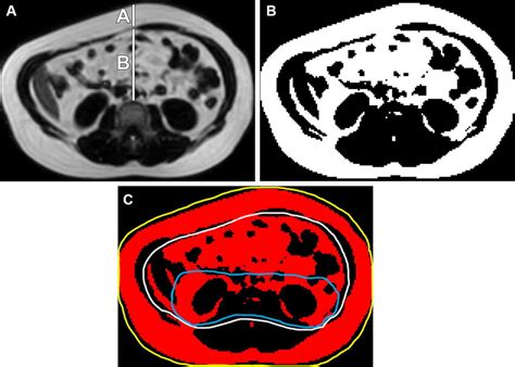 Measurement Of Abdominal Fat Stores On Axial Mr Images Obtained Of An