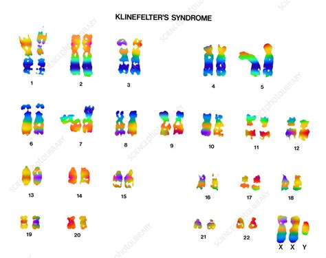 Klinefelter S Syndrome Karyotype Stock Image C Science