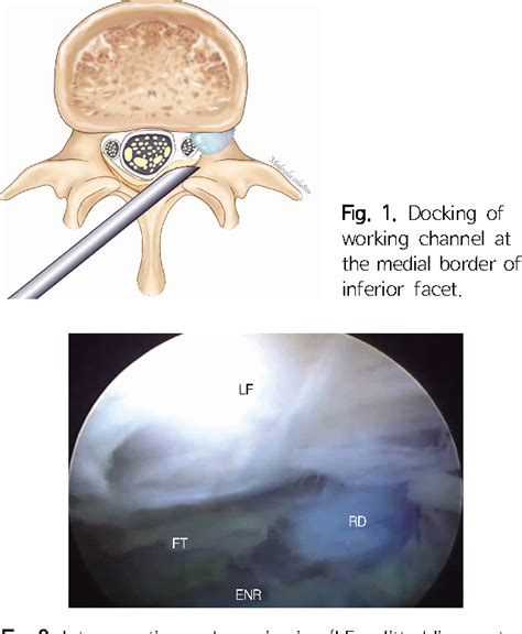 Figure 1 From Percutaneous Endoscopic Lumbar Discectomy For L5 S1