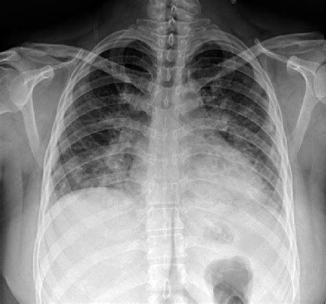Chest X Ray Posteroanterior View Shows Ill Defined Patches Of
