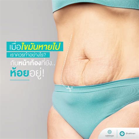 ตัดหนังหน้าท้อง tummy tuck แก้ปัญหาหน้าท้องย้วย หย่อนยาน ไม่กระชับ