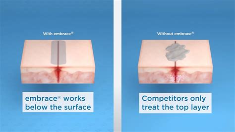 See How Embrace® Is Redefining Scar Therapy Youtube