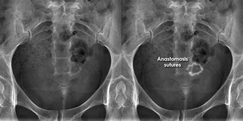 Abdominal X Ray Artifacts Anastomosis Sutures