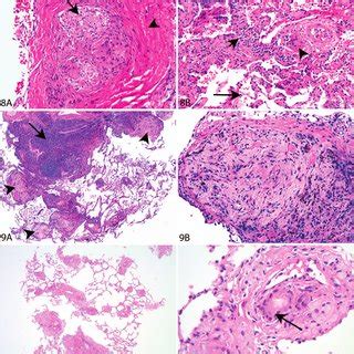 Exogenous Lipoid Pneumonia In A Transbronchial Lung Biopsy A Low