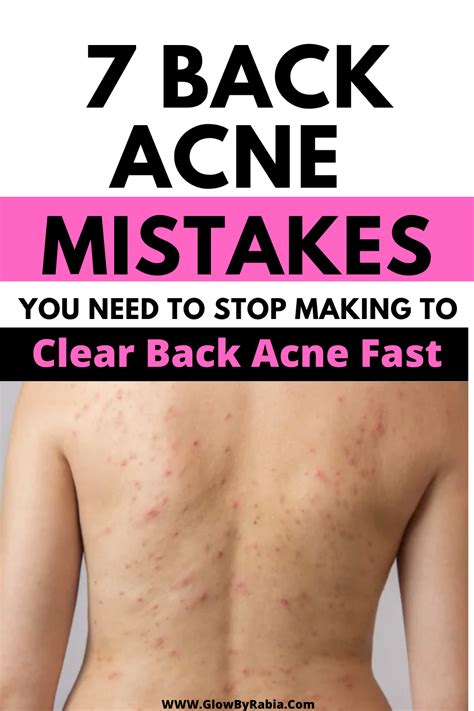 Everything You Need To Know About Treating Back Acne Artofit