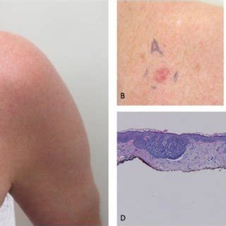 New Primary Cutaneous Superficial Basal Cell Carcinomas Bccs During Download Scientific