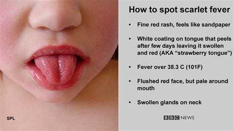 New Strain Of Toxin Producing Strep A Emerges In UK BBC News