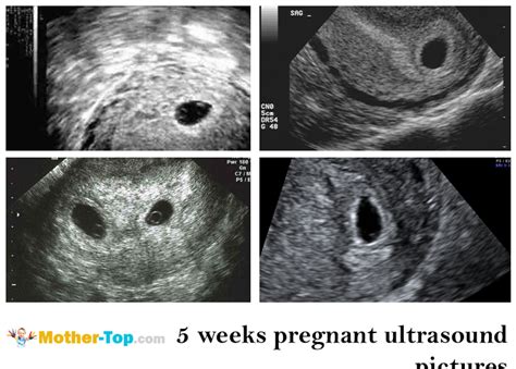 Pregnancy At 5 Weeks Ultrasound Pregnancywalls