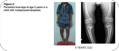 What Causes Bow Legs In Childrens Pinnacle Orthocentre Hospital