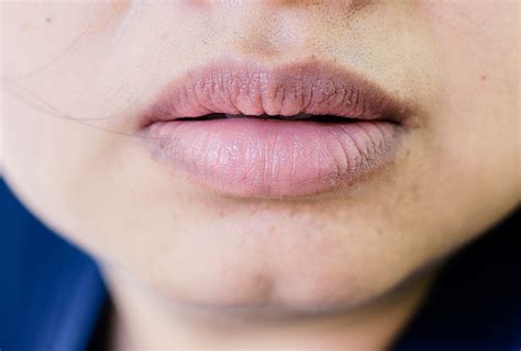 Home Remedies For Dark Lips Top 10 Home Remedies