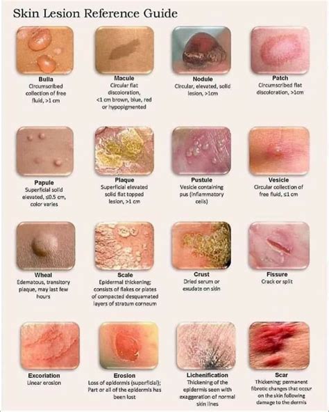 Skin Lesion Identification Chart