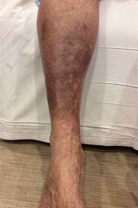Presumir Ópera Positivo Skin Discoloration On Legs Missionário Físico Expulsar
