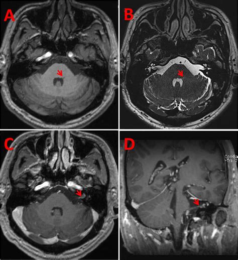 Mri Results Of Patient 2 Mri Showed Low T1 Mprage And High T2