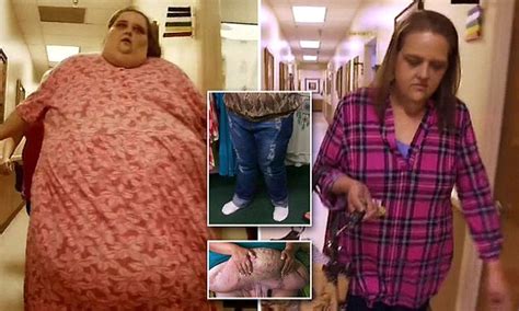 Woman Who Lost Nearly 400lbs Celebrates Having 50lbs Of Excess Skin Surgically Removed Daily