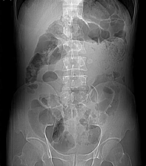 A Contrast Enhanced CT Of The Abdomen Showed A Clear Invagination Of