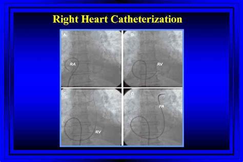Right Heart Catheterization Swan Ganz Catheter Swan Ganz Catheter