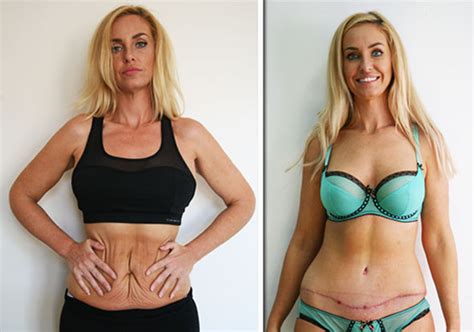 Weight Loss Josie Gibson Reveals Tummy Tuck Before And After Pictures Uk
