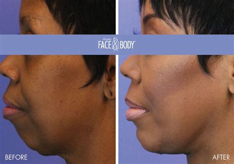 Transformationtuesday A Chin Implant Is A Great Option For Those