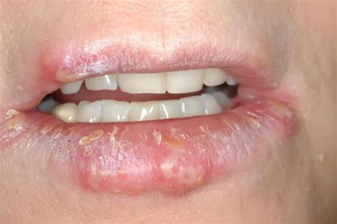 Infectious Cheilitis