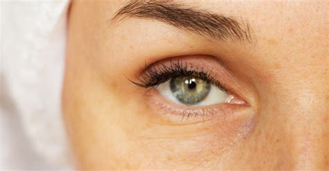 Eye Basics 101 What Causes Puffy Eyes Eyelux Optometry