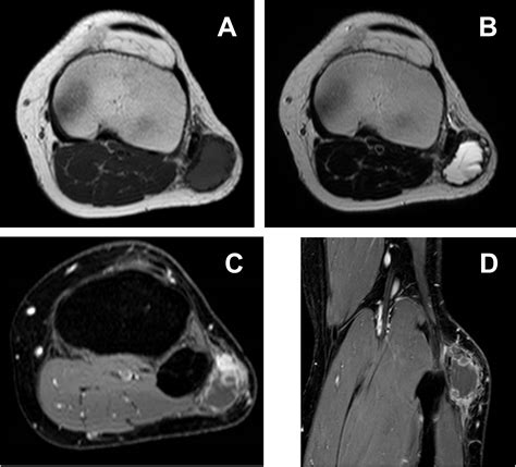 Frontiers Case Report Extraskeletal Osteosarcoma With Preceding