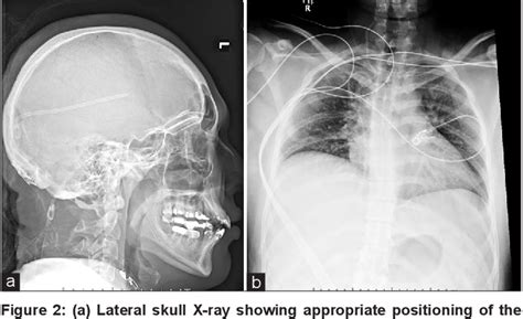 Figure 2 From Feasibility Of A Fourth Ventriculopleural Shunt For