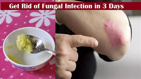 Use Garlic This Way To Get Rid Of Fungal Infections In 3 Days Home
