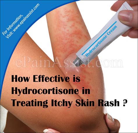 However, you can have intensely itchy skin and see nothing on your skin. How Effective is Hydrocortisone in Treating Itchy Skin Rash?