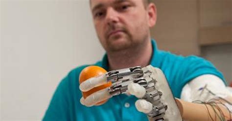 Amputee Gets First Prosthetic Hand That Allows Sense Of Touch Cbs News