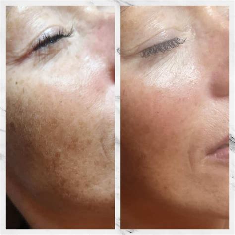 Dermaplaning Pros And Cons Before And After Pictures