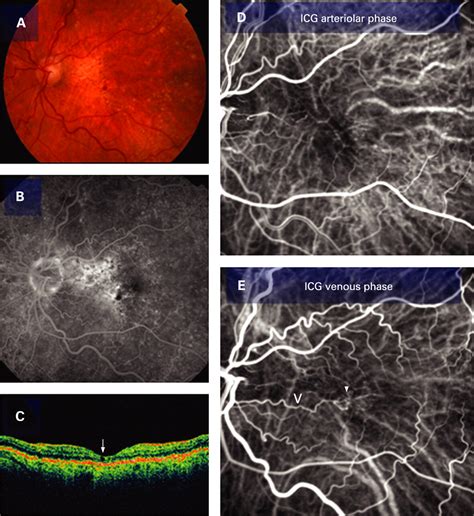 The Role Of Dynamic Indocyanine Green Angiography In The Diagnosis And