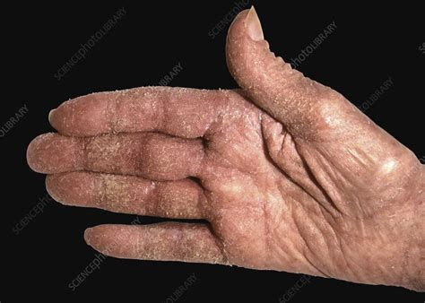 Crusted Scabies Lesions On Hand Stock Image C0482895 Science