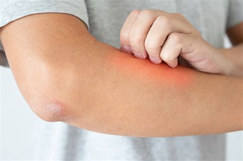 Young Asian Man Itching And Scratching On Arm From Itchy Dry Skin