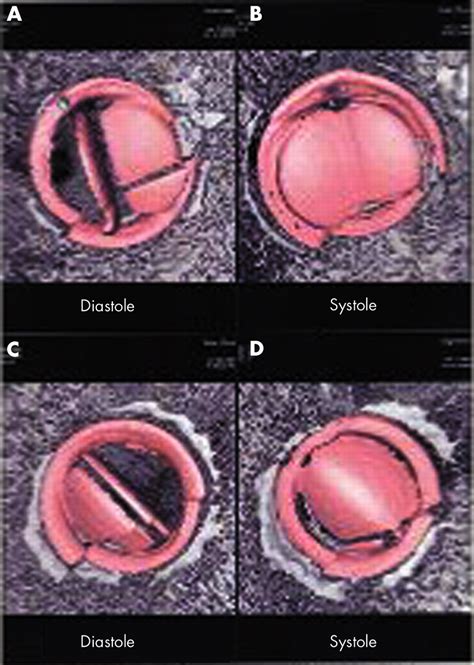 Blockage Of Bileaflet Mitral Valve Prosthesis Imaged By Computed