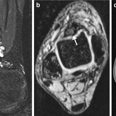 Mri Findings Of Tenosynovial Giant Cell Tumor With Local Erosion A B