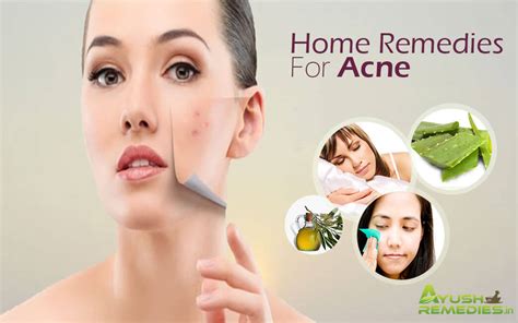 13 Most Effective Home Remedies For Acne You Must Try