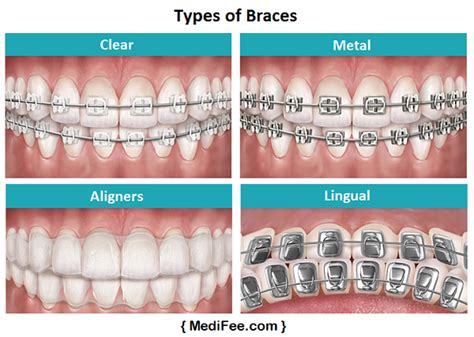 Dental Braces Treatment In India