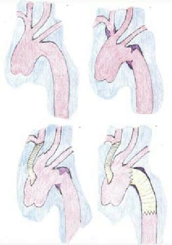 A Bovine Aortic Arch Anatomy B Injuries At The Level Of The