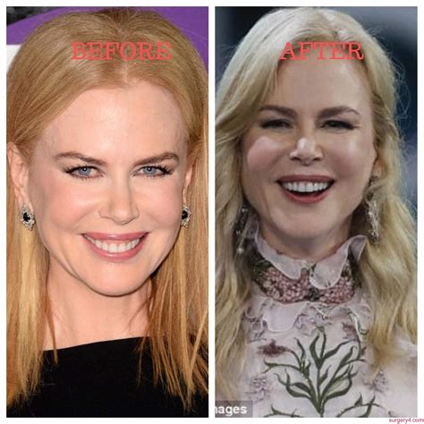 Nicole Kidman Plastic Surgery Photos Before And After ⋆ Surgery4