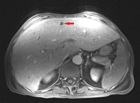 Liver Segments Mri